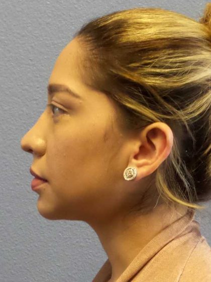 Liposuction of the Neck Before & After Patient #12082
