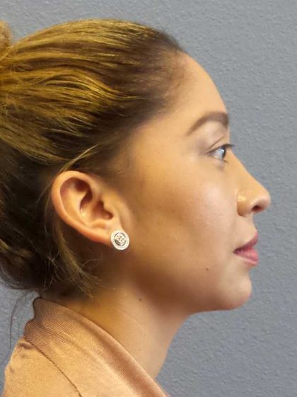 Liposuction of the Neck Before & After Patient #12082
