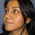 Rhinoplasty Before & After Patient #12384