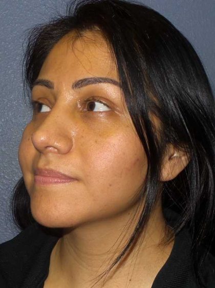 Rhinoplasty Before & After Patient #12384