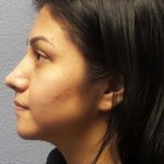 Rhinoplasty Before & After Patient #12384