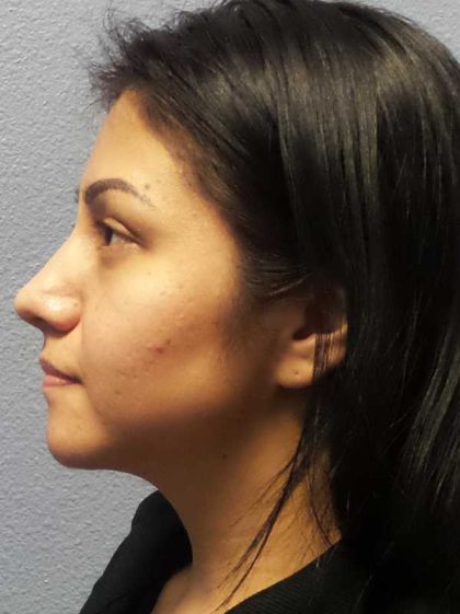 Rhinoplasty Before & After Patient #12384