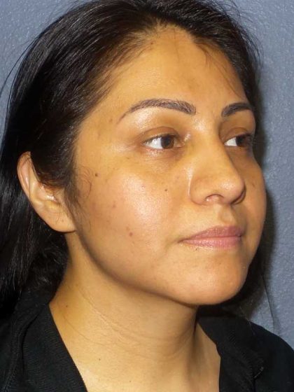 Rhinoplasty Before & After Patient #12384