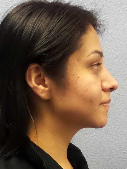 Rhinoplasty Before & After Patient #12384