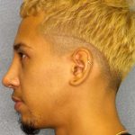 Rhinoplasty Before & After Patient #12373