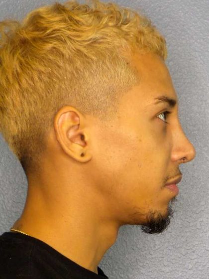 Rhinoplasty Before & After Patient #12373