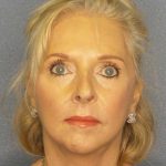 Facelift Before & After Patient #7577