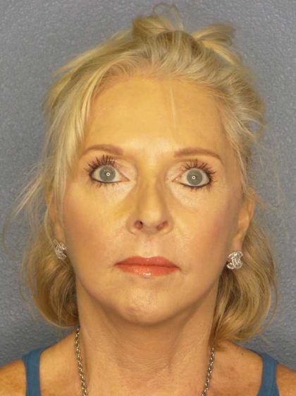 Facelift Before & After Patient #7577