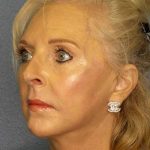 Facelift Before & After Patient #7577