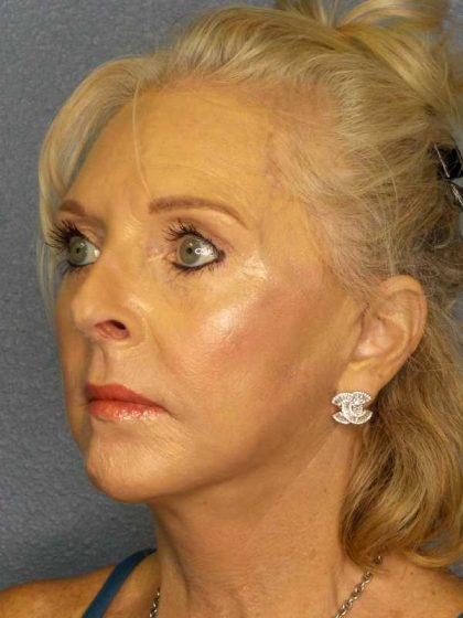 Facelift Before & After Patient #7577