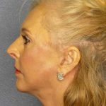 Facelift Before & After Patient #7577