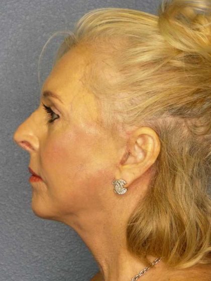 Facelift Before & After Patient #7577