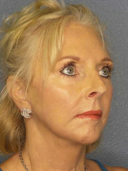 Facelift Before & After Patient #7577