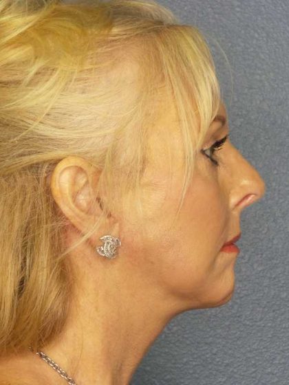 Facelift Before & After Patient #7577
