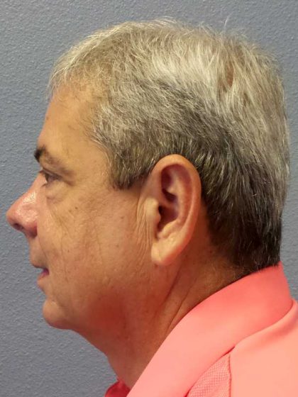 Rhinoplasty Before & After Patient #10211