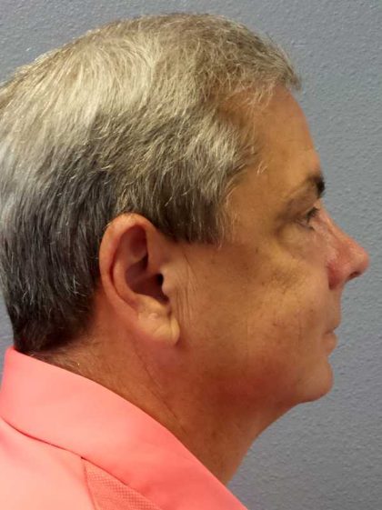 Rhinoplasty Before & After Patient #10211