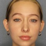 Rhinoplasty Before & After Patient #9761