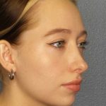 Rhinoplasty Before & After Patient #9761
