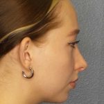 Rhinoplasty Before & After Patient #9761