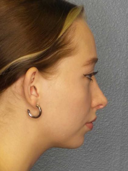 Rhinoplasty Before & After Patient #9761