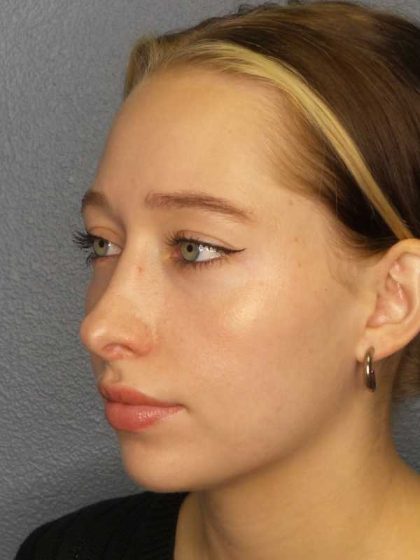 Rhinoplasty Before & After Patient #9761