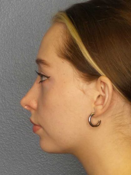 Rhinoplasty Before & After Patient #9761