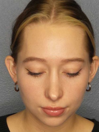 Rhinoplasty Before & After Patient #9761