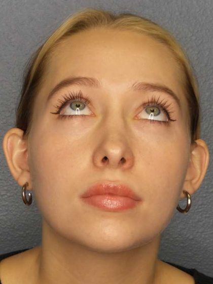 Rhinoplasty Before & After Patient #9761