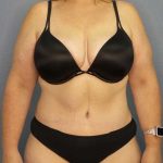 High BMI (Larger Patients) Surgery Before & After Patient #10381