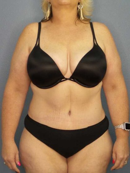 High BMI (Larger Patients) Surgery Before & After Patient #10381