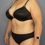 High BMI (Larger Patients) Surgery Before & After Patient #10381