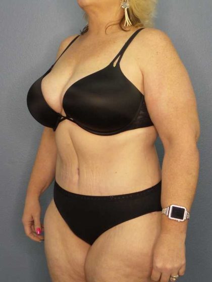 High BMI (Larger Patients) Surgery Before & After Patient #10381