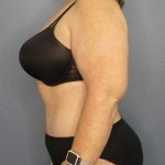 High BMI (Larger Patients) Surgery Before & After Patient #10381