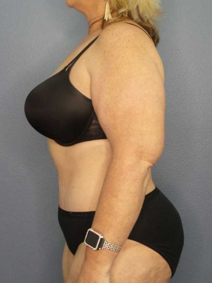 High BMI (Larger Patients) Surgery Before & After Patient #10381
