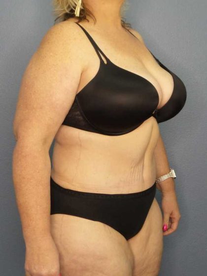 High BMI (Larger Patients) Surgery Before & After Patient #10381