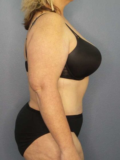 High BMI (Larger Patients) Surgery Before & After Patient #10381