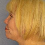 Facelift Before & After Patient #7573