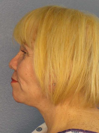 Facelift Before & After Patient #7573