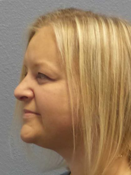 Facelift Before & After Patient #11629