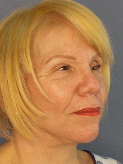 Facelift Before & After Patient #7573