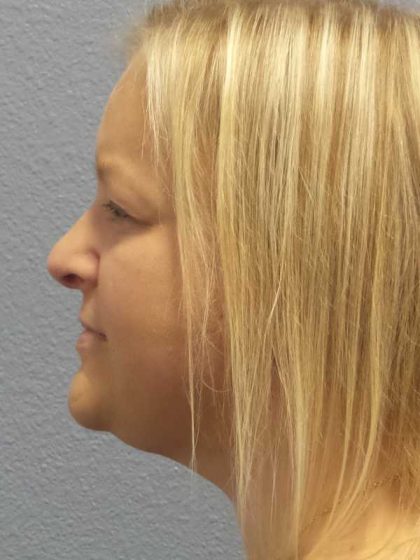 Facelift Before & After Patient #11629