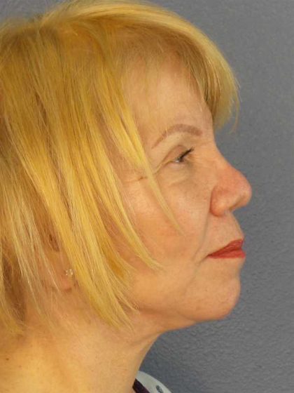 Facelift Before & After Patient #7573