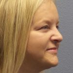 Facelift Before & After Patient #11629