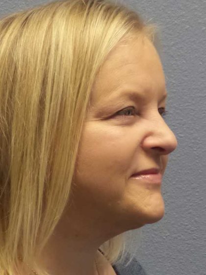Facelift Before & After Patient #11629
