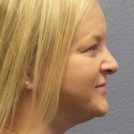 Facelift Before & After Patient #11629