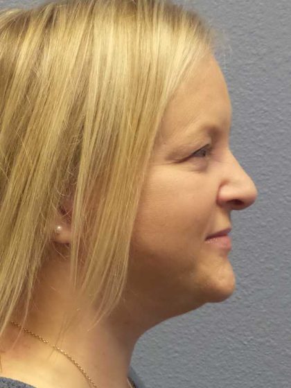 Facelift Before & After Patient #11629