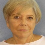 Facelift Before & After Patient #11683