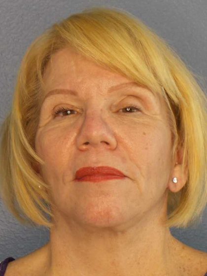 Facelift Before & After Patient #7573