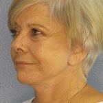 Facelift Before & After Patient #11683