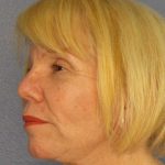 Facelift Before & After Patient #7573